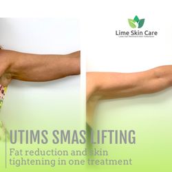 Lime Skin Care - Utims Smas Lifting