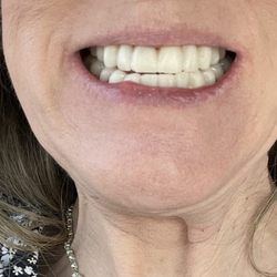 Comfort Dental - South Tacoma - Various colors, bad outcome, constant pain