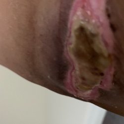 Surgery Center of Potomac - Right arm