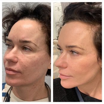 Austin Regenerative Therapy - Pre and Post PRP non surgical facelift, micro needling and PDO threads. - Alternative Medicine Near Me - Austin, Texas