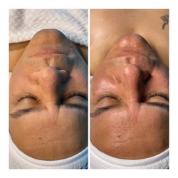 MoonGLO Aesthetics - Before/after mens HydraFacial