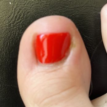 True Touch Nail 4 - Infected side of toe where nail tech cut me - Nail Salons Near Me - Peoria, Arizona