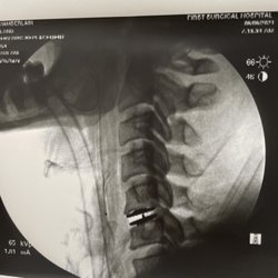 Neil Badlani, MD MBA - My X-ray after surgery.