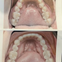 PDA Dental - Before: top, After: bottom