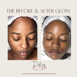 Acne clearing Monthly facial results