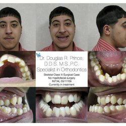 Douglas R. Prince - BEFORE BRACES