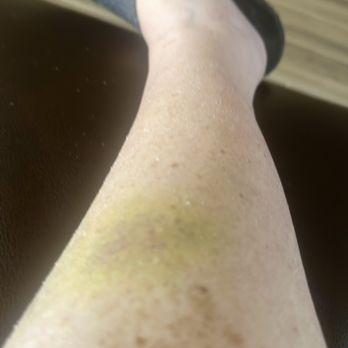 Norwood Furniture - One of dozens of bruises-this photo was taken today-bruise is about a week old - Furniture Stores Near Me - Gilbert, Arizona