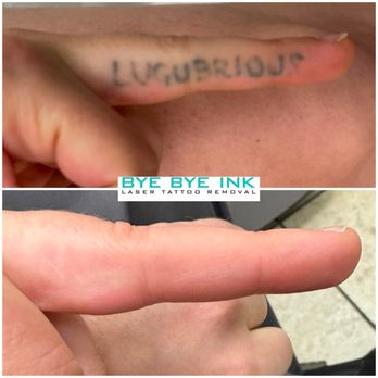 Bye Bye Ink - Laser tattoo removal, 3 sessions and gone! - Tattoo Removal Near Me - Middle Village, New York Bye Bye Ink - Laser tattoo removal, 3 sessions and gone! - Tattoo Removal Near Me - Middle Village, New York