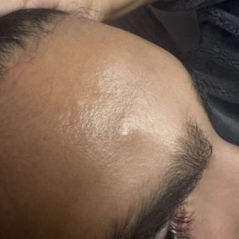 Nicholas Bastidas, MD - Screw sticking out - Plastic Surgeons Near Me - New York, New York Nicholas Bastidas, MD - Screw sticking out - Plastic Surgeons Near Me - New York, New York