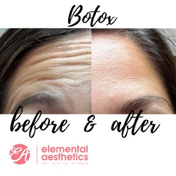 Elemental Aesthetics - Lovely Botox results for our lovely patient. - Skin Care Near Me - Mesa, Arizona