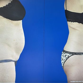 Body Contourz - 9 inch Weight loss after 6 Ultra Slim Treatments - Weight Loss Centers Near Me - North Hollywood, California Body Contourz - 9 inch Weight loss after 6 Ultra Slim Treatments - Weight Loss Centers Near Me - North Hollywood, California