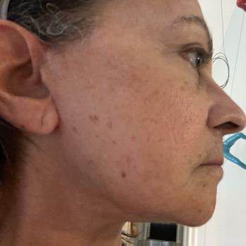 Alan Serure, MD - "After" - Cosmetic Surgeons Near Me - South Miami, Florida