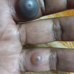 Russell Dermatology Of Conway - My blood filled index finger was so big I couldn't bend it. It was suppose to look like my ring finger.