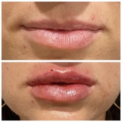 The Beauty PA - Lip Filler
