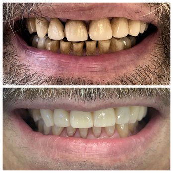 Silver Spring Dental Center - B&A: Deep Cleaning, Stain Removal, Porcelain Crowns - Endodontists Near Me - Silver Spring, Maryland