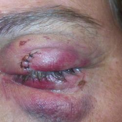 Geoffrey M. Kwitko, MD, FACS - Eye injury