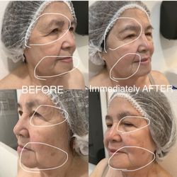 Radiant Beauty Skin Care Med Spa - ULTHERAPY whole face skin tightening