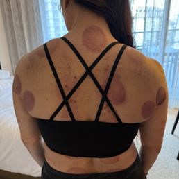 Fire cupping by Andy