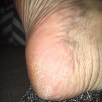 Nj Nails Spa - This is my heel just a few hours after leaving - Waxing Near Me - Novato, California Nj Nails Spa - This is my heel just a few hours after leaving - Waxing Near Me - Novato, California