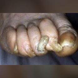 SF Fungal Nail Treatment Clinic