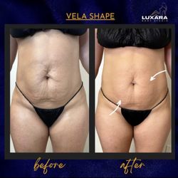 Luxara Body Studio - Have you just became a mommy? Lose skin on your belly from your newborn baby ? Let us help you snatch it back with non surgical treatment.