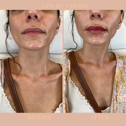Dolce Lounge Aesthetics Wellness - Lips by Cheryl RN
