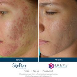 Oak Park Laser and Skin Clinic - Acne Marks before and after microneedling