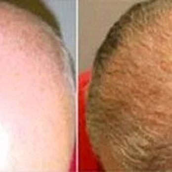 Irwin B Simon, MD - Dr. Simon of Vegas Valley Hair Restoration - Before and After photo - Doctors Near Me - Henderson, Nevada Irwin B Simon, MD - Dr. Simon of Vegas Valley Hair Restoration - Before and After photo - Doctors Near Me - Henderson, Nevada