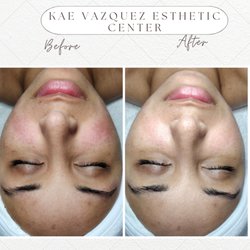 KAE v