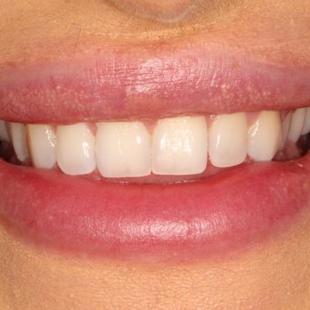 Downtown Dentist SF - Before - Cosmetic Dentists Near Me - San Francisco, California