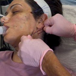 Me doing the procedure!
