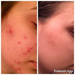 Regenesis Skin Studio - Acne treatment done with the Jet Clear and oxygen RX .