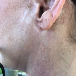 Left ear scarring in front. Left ear scarring in front.