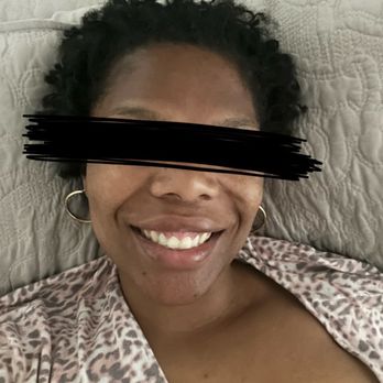 Ideal Image Jacksonville - One month post op - Laser Hair Removal Near Me - Jacksonville, Florida Ideal Image Jacksonville - One month post op - Laser Hair Removal Near Me - Jacksonville, Florida