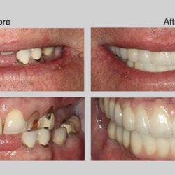 Brentwood Cosmetic Dentist, Haroun Rostami DDS - Before/After