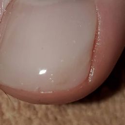 After the toenail reconstruction by Kari