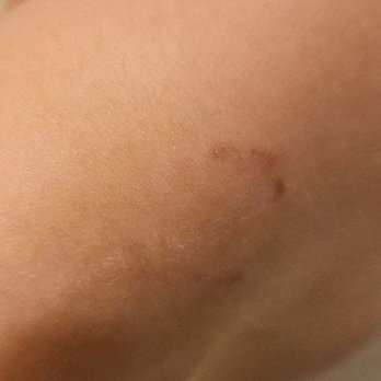 New Horizon Academy - The unreported bite mark. - Child Care & Day Care Near Me - Broomfield, Colorado New Horizon Academy - The unreported bite mark. - Child Care & Day Care Near Me - Broomfield, Colorado