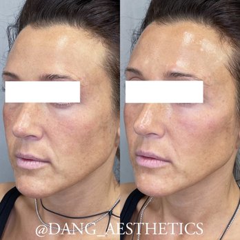 Dang Aesthetics - Dermal Filler Cheek Lift - Medical Spas Near Me - Cedar Park, Texas