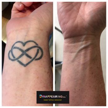 Removery Tattoo Removal & Fading - Tattoo Removal Near Me - Framingham, Massachusetts Removery Tattoo Removal & Fading - Tattoo Removal Near Me - Framingham, Massachusetts