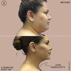 AirSculpt - Charlotte