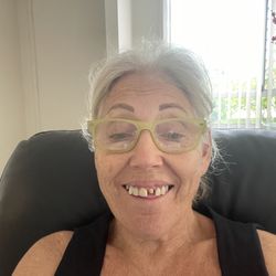 Nerang Street Dental Clinic - My broken Vaneer