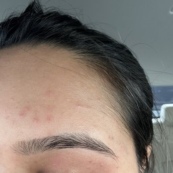 Super Eyebrow - Pimple and injury - Hair Removal Near Me - Pittsburg, California Super Eyebrow - Pimple and injury - Hair Removal Near Me - Pittsburg, California