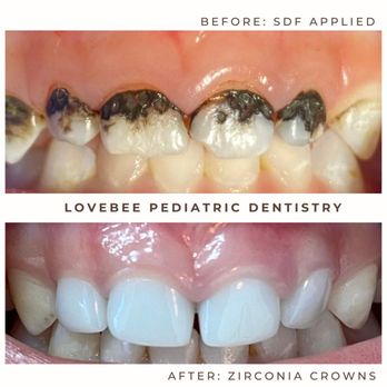 Lovebee Pediatric Dentistry - Zirconia Crowns - Pediatric Dentists Near Me - Tustin, California Lovebee Pediatric Dentistry - Zirconia Crowns - Pediatric Dentists Near Me - Tustin, California