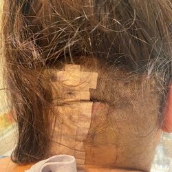 Wesley A King, MD-The Center For Minimally Invasive Neurosurgery - Two days post-surgery.