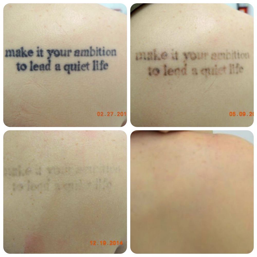 ZAPATAT 173 Photos & 84 Reviews Tattoo Removal 2731 Washington