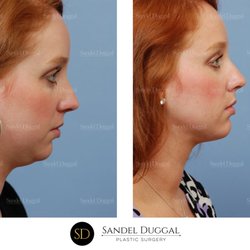 Sandel Duggal Center for Plastic Surgery and Medspa - Neck and chin liposuction by Dr. Henry Sandel. Before left, after right. Individual results vary.