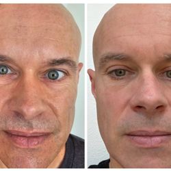 Urban Laser - This gentleman was looking for a refresher to even his skin tone and help with baby fine lines this is after one baby CO2