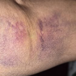 Labcorp - After day 3... this is what she did!