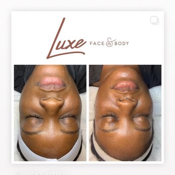 Luxe - Body Contouring Near Me - Tampa, Florida