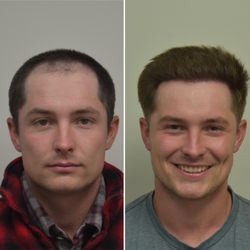 Los Angeles FUE Hair Transplant Clinic - Only 6 months post #FUE Hair Restoration @50% growth. Double density still to come following next 10 months. Client had over 3000 FUE Grafts